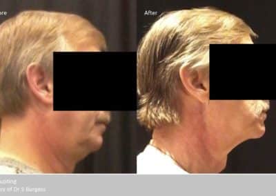 before and after photo of a Coolsculpting treatment on a mans chin area