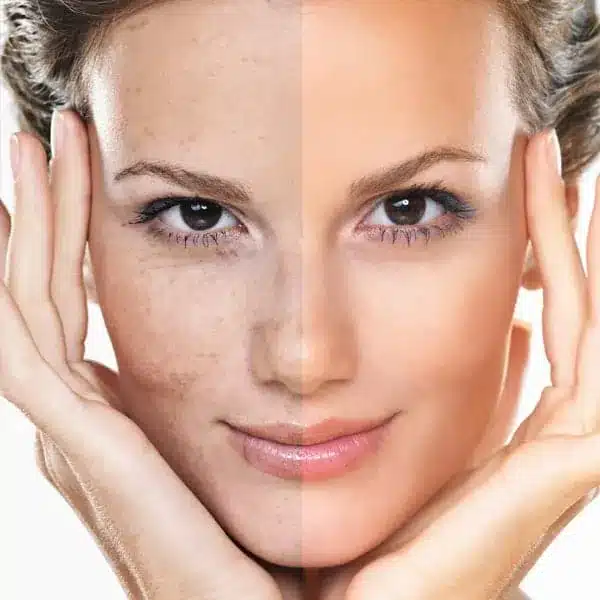woman's face showing before and after using IPL Pulsed Light Laser treatment